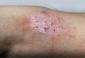 eczema psoriasis remedies
