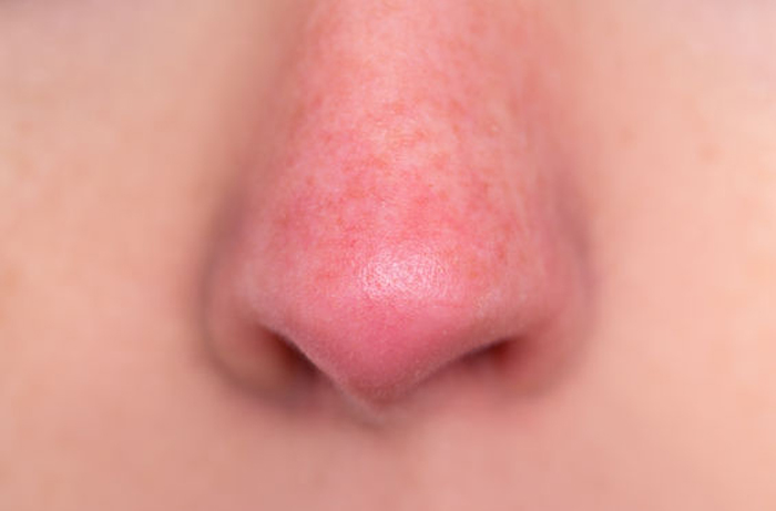 What Is Rosacea – Signs and Symptoms